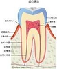むし歯